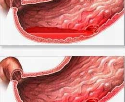 Làm gì khi có các triệu chứng nghi ngờ Thủng ổ loét dạ dày – tá tràng 